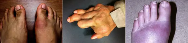 Beispiele für Gicht an Füßen und Händen. Beachten Sie, dass die Hand in der Mitte wahrscheinlich gleichzeitig von einer anderen Arthritis betroffen ist, wie z. B. rheumatoider Arthritis und Gicht, die die starke Schwellung verursacht. Klicken um zu vergrößern.