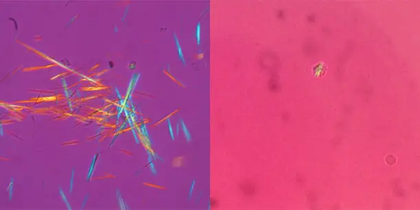 Gichtkristalle (links) und Pseudogichtkristalle (rechts) unter dem Mikroskop. Uratkristalle haben scharfe, nadelartige Enden, während CPPD-Kristalle eher wie Stäbchen oder Rauten geformt sind.