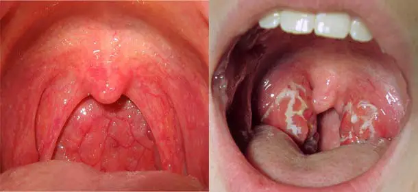 Halsschmerzen (links) und Halsentzündungen (rechts).
